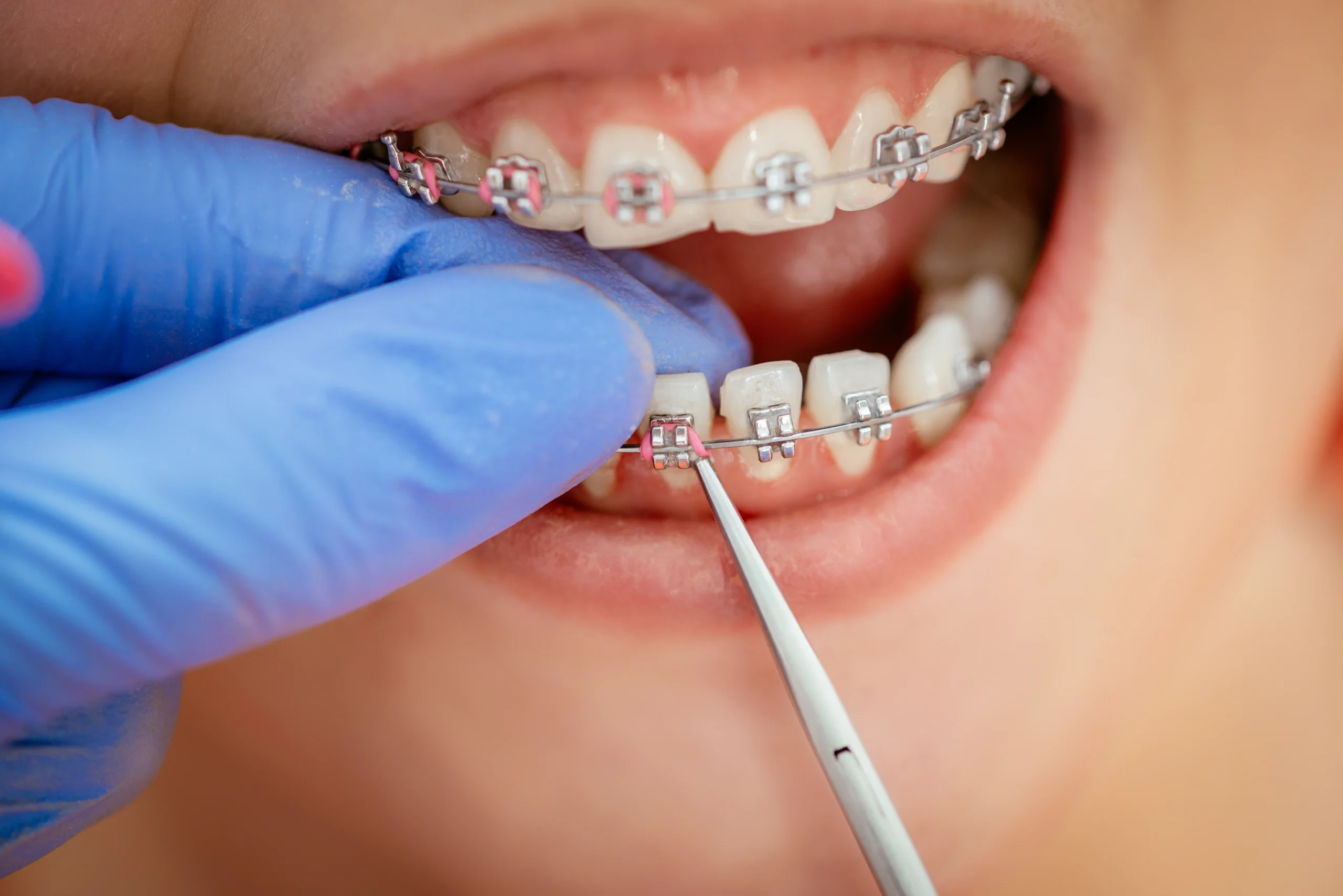 Braces and orthodontic treatment at Union Family Dental