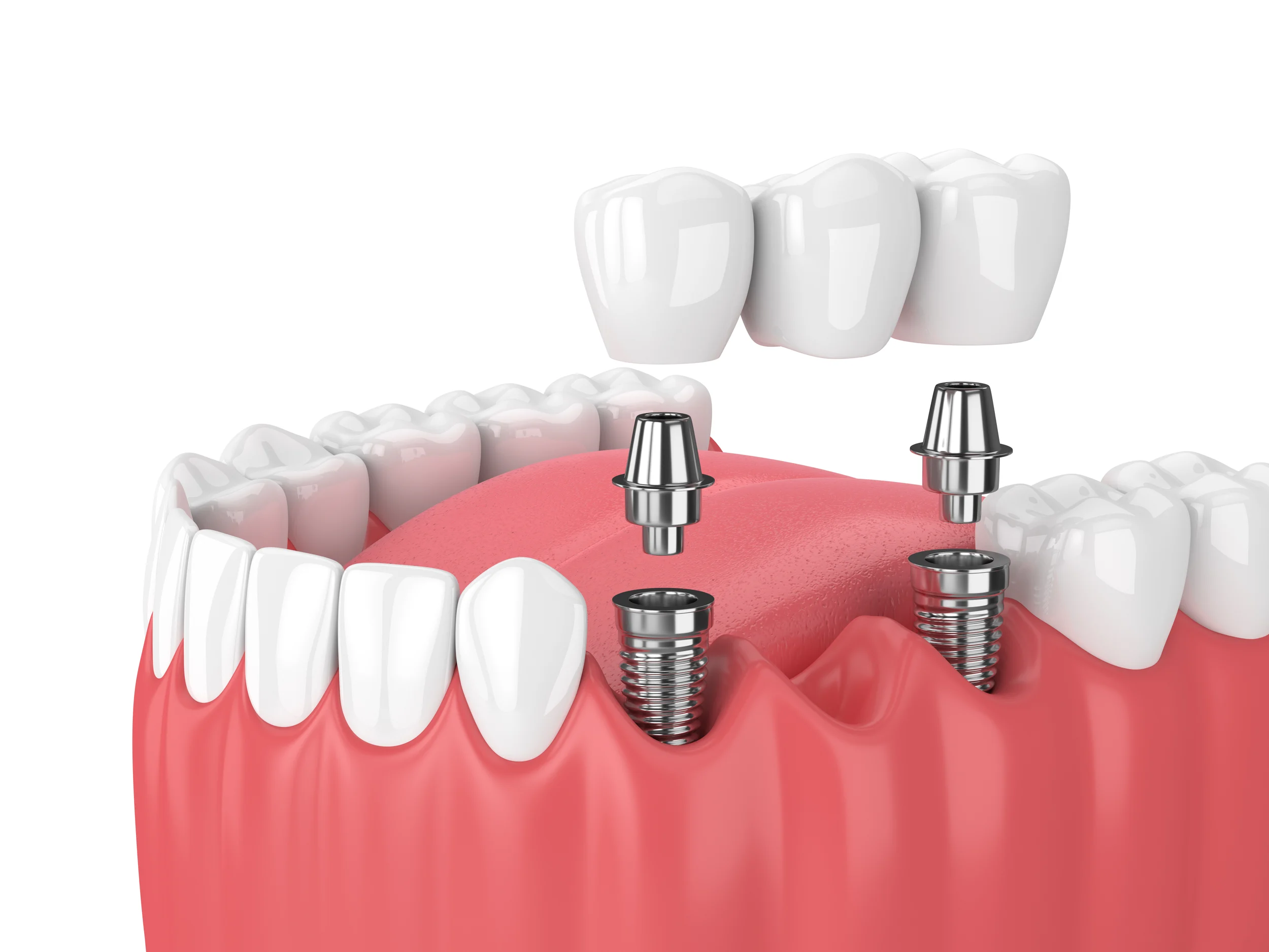 Dental bridges at Union Family Dental