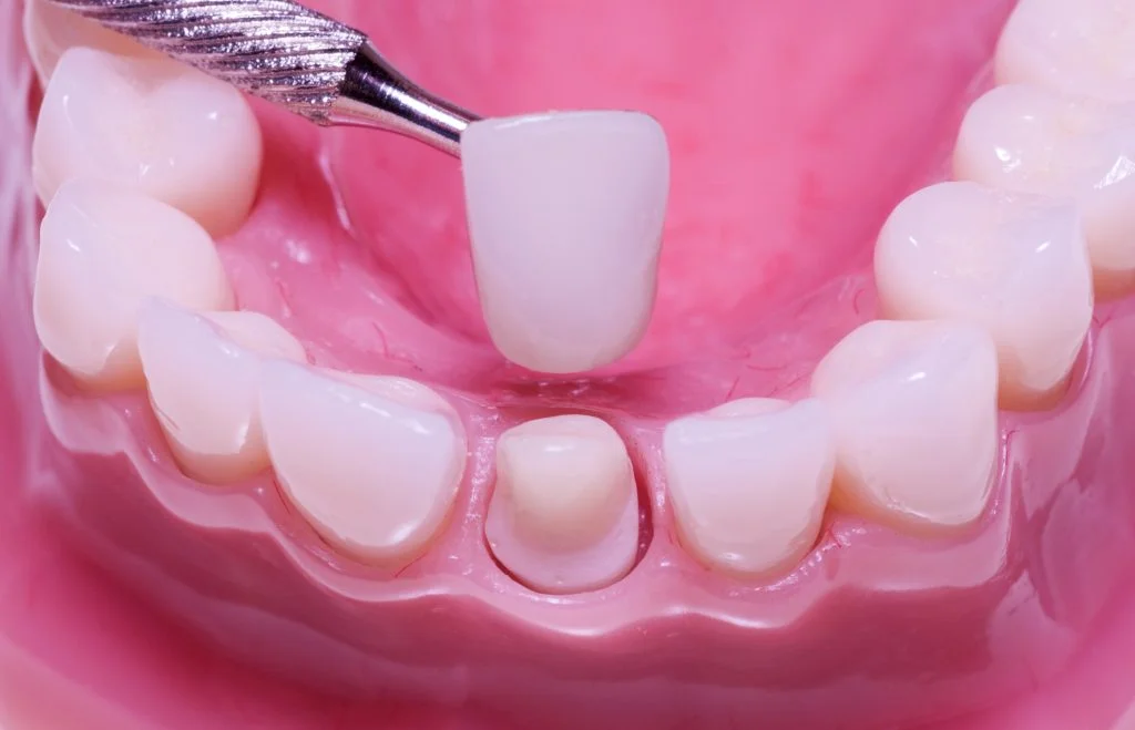 Dental crowns at Union Family Dental