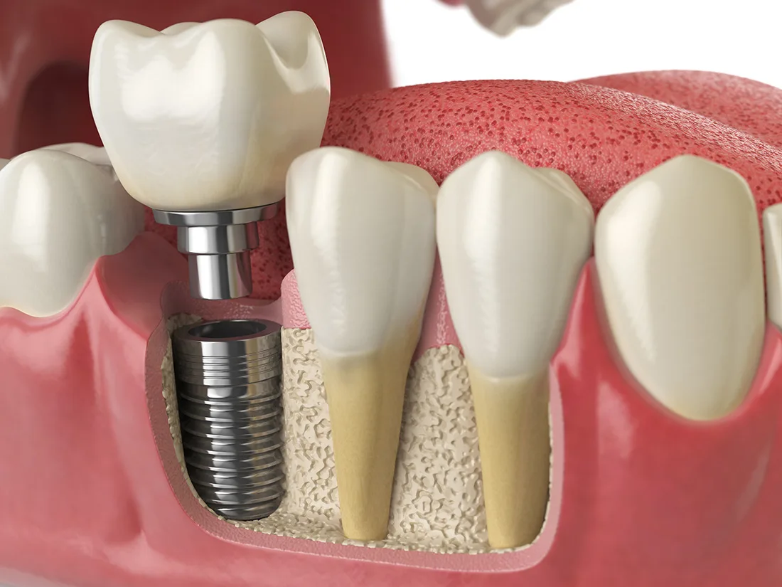 Dental implants and restorations at Union Family Dental