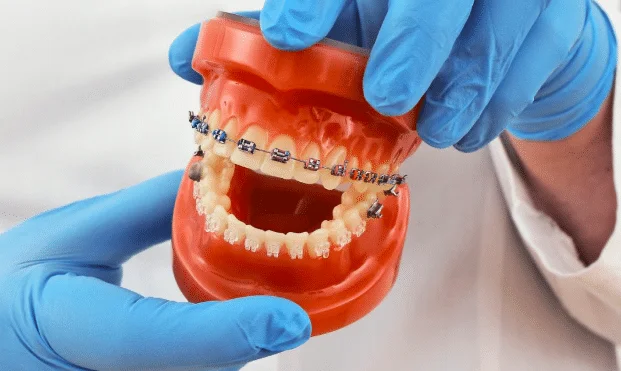 Orthodontics at Union Family Dental