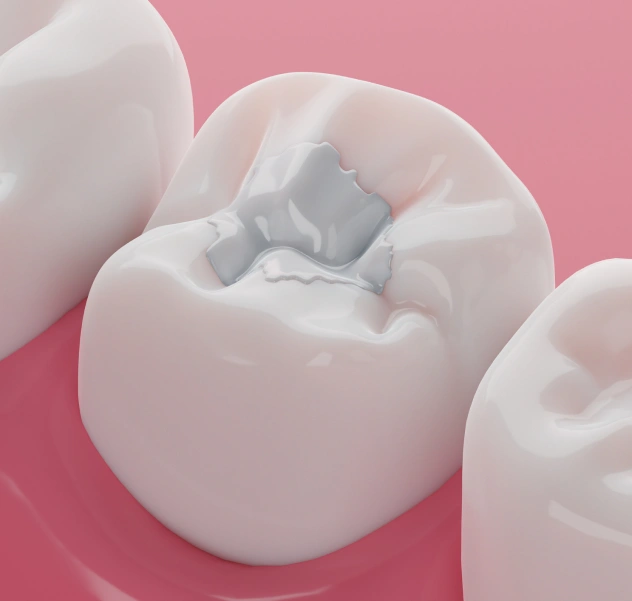 Tooth-colored dental fillings at Union Family Dental