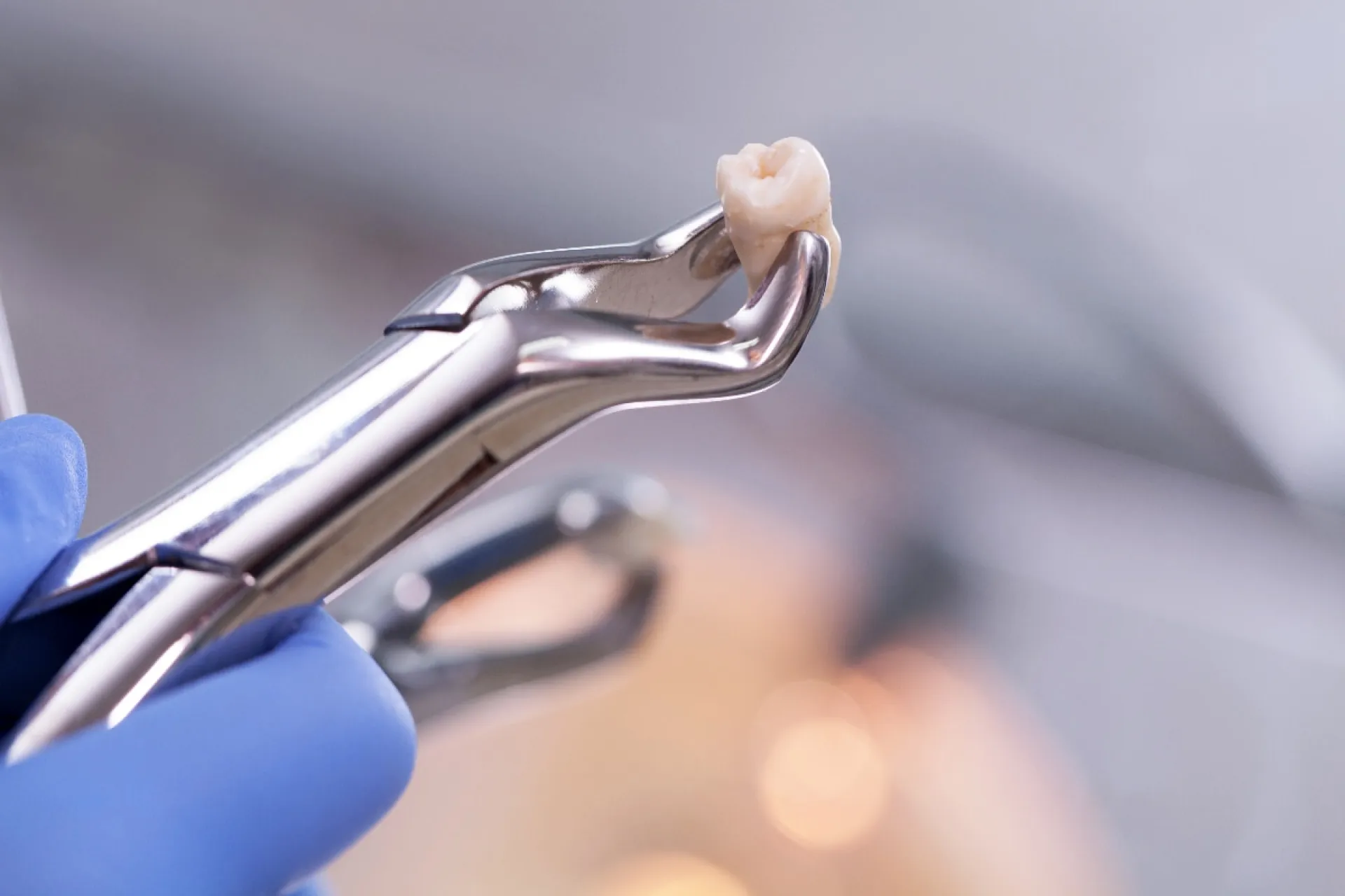 Tooth extractions at Union Family Dental