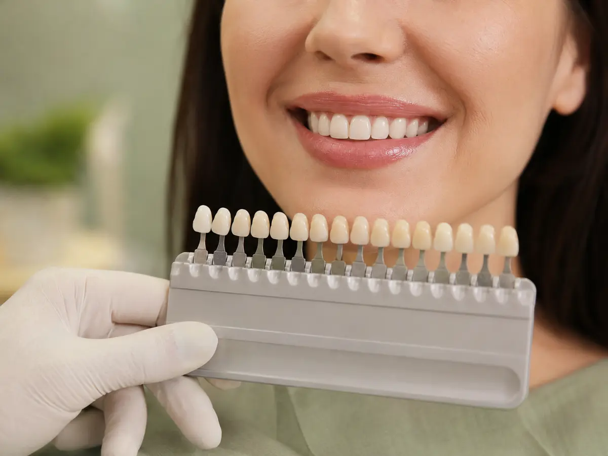 Porcelain veneers at Union Family Dental