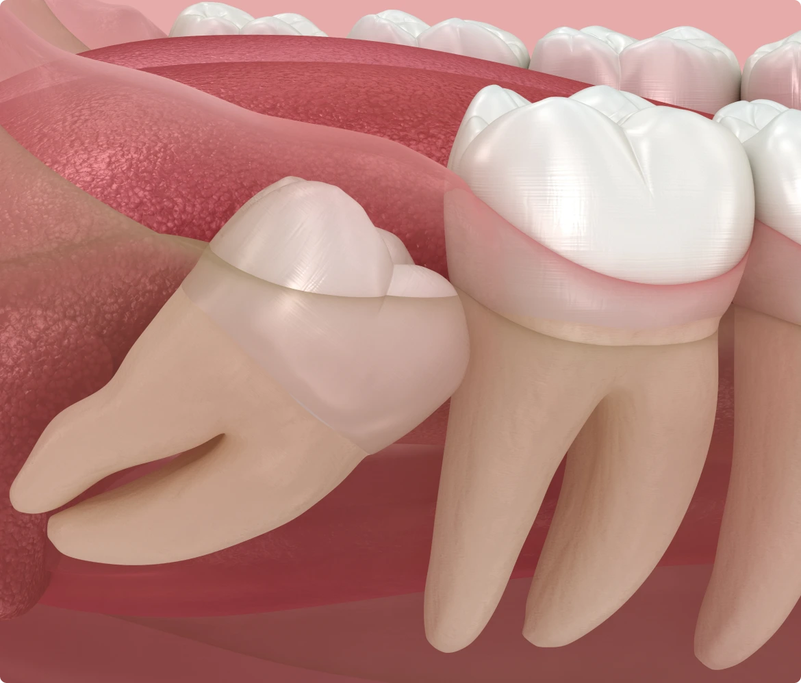 Wisdom teeth removal at Union Family Dental